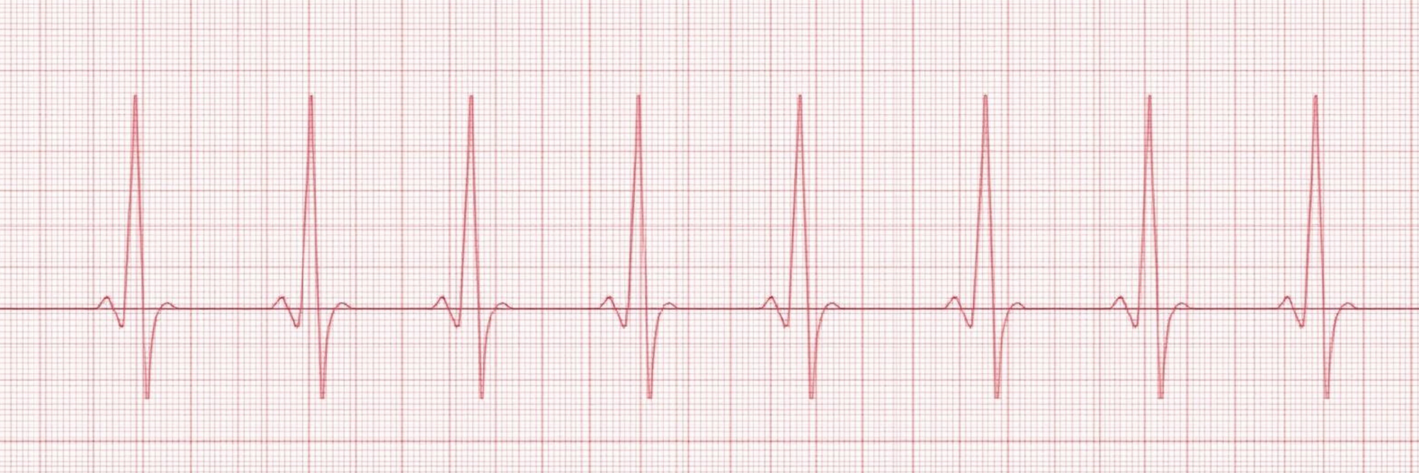 What Does Bradycardia Mean for a Newborn in the NICU?