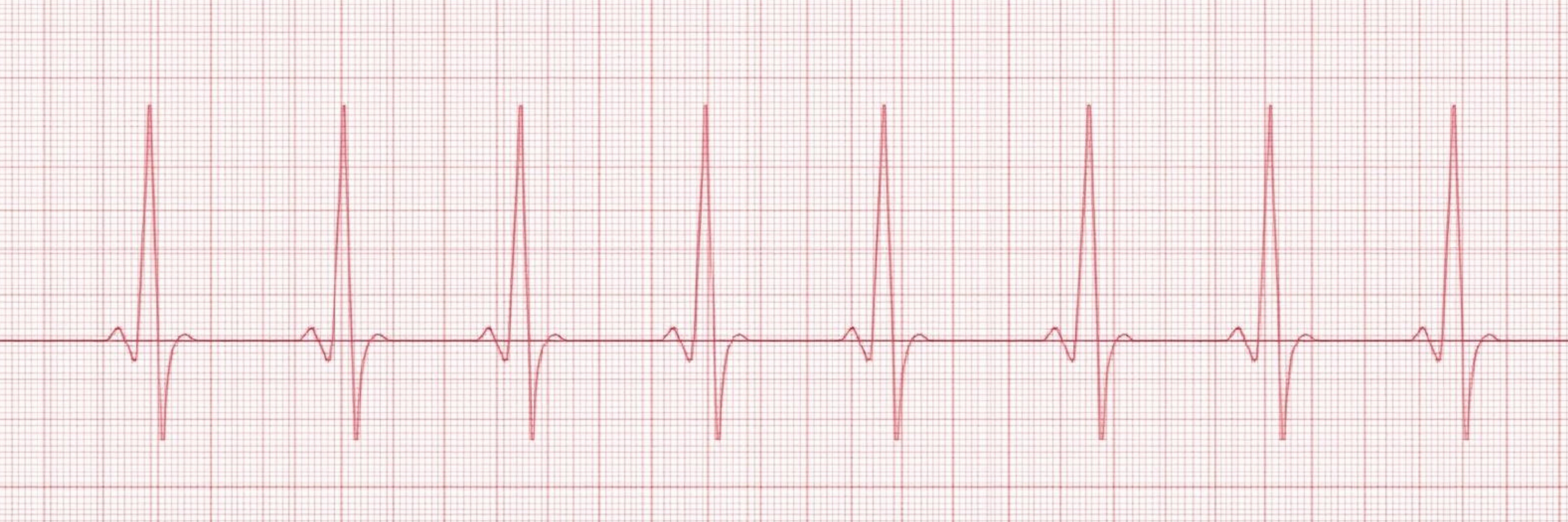 What Does Bradycardia Mean for a Newborn in the NICU?
